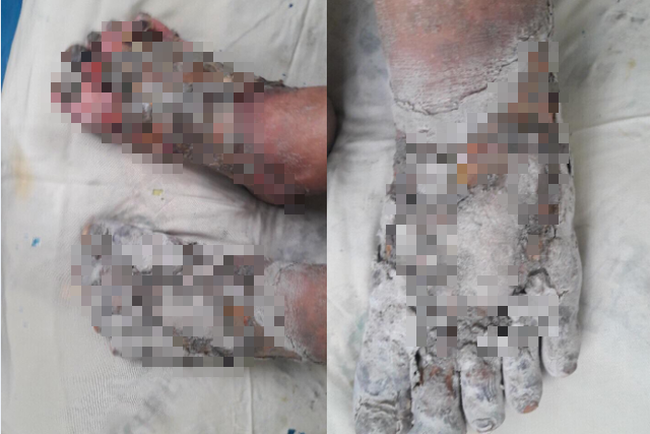 Phải cắt cụt chân vì tự ý dùng thuốc lá chữa tiểu đường