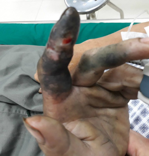 Hoại tử ngón tay do đắp thuốc nam vào vết rắn hổ mang cắn