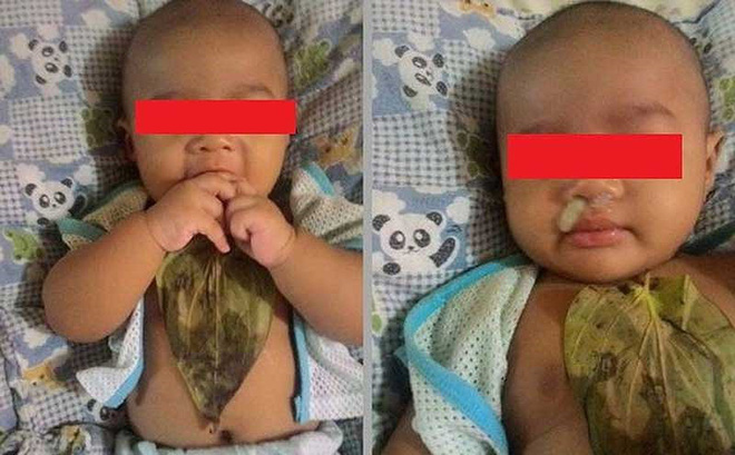 Gây hại con trẻ vì tin vào bài thuốc dân gian