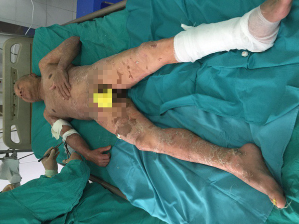 Tổn thương 90% da khi dùng thuốc nam điều trị u phì đại tuyến tiền liệt