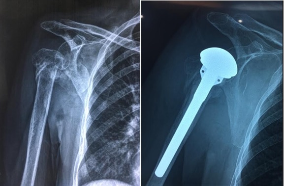 Suýt liệt tay vì bó thuốc nam chữa gãy trật khớp vai